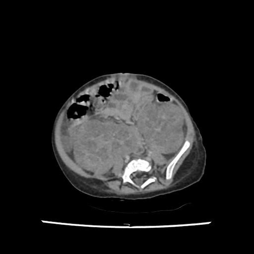 File:Caroli disease with autosomal recessive polycystic kidney disease (ARPKD) (Radiopaedia 89651-106703 B 158).jpg