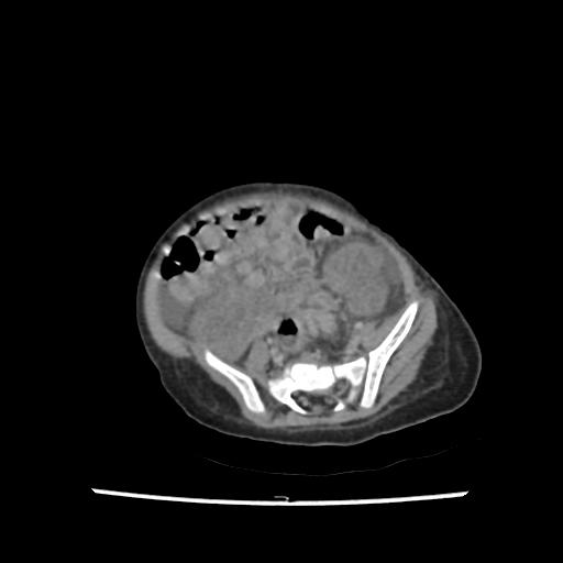 File:Caroli disease with autosomal recessive polycystic kidney disease (ARPKD) (Radiopaedia 89651-106703 B 175).jpg
