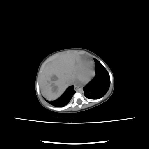 Caroli disease with autosomal recessive polycystic kidney disease (ARPKD) (Radiopaedia 89651-106703 E 19).jpg