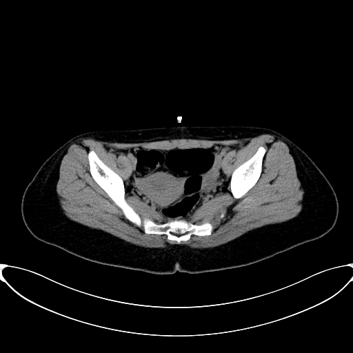 File:Caroli disease with medullary sponge kidney (Radiopaedia 82622-96804 Axial non-contrast 65).jpg