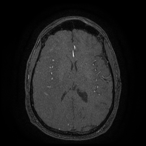 Carotid arterial dissection with acute cerebral infarction (Radiopaedia 26636-26784 MRA 62).jpg