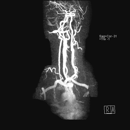 File:Carotid artery dissection (Radiopaedia 28441-28689 MIP Carotids MRA 12).jpg