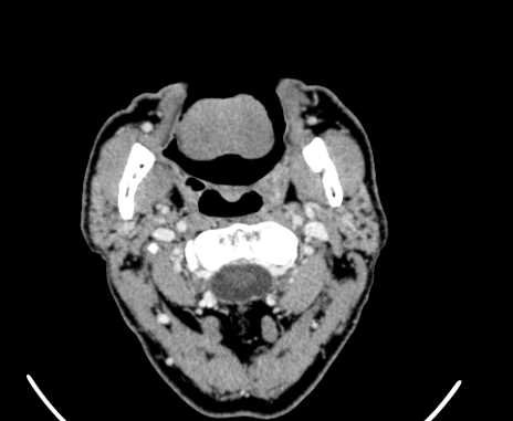 Carotid body tumor (Radiopaedia 61750-69757 Axial Post contrast 20).jpg