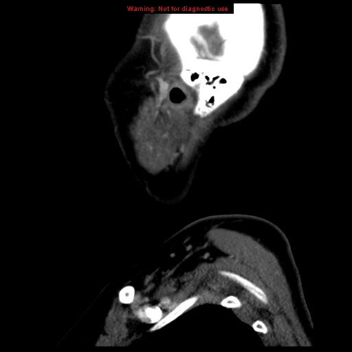 Carotid body tumor with lung metastases (Radiopaedia 9301-9986 Sagittal C+ delayed 50).jpg