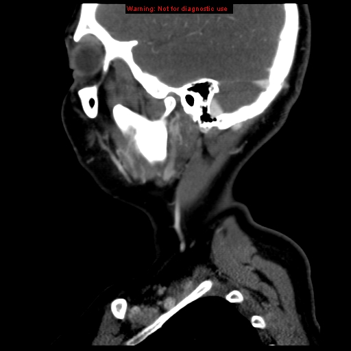 Carotid body tumor with lung metastases (Radiopaedia 9301-9986 Sagittal C+ delayed 8).jpg