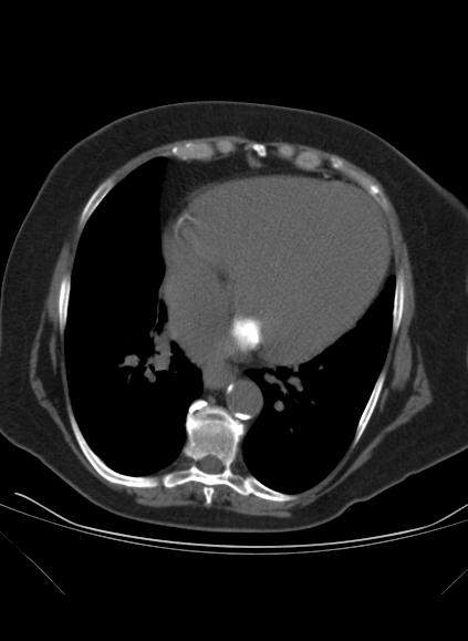 File:Caseous mitral annular calcification (Radiopaedia 61219-69122 Axial non-contrast 12).jpg