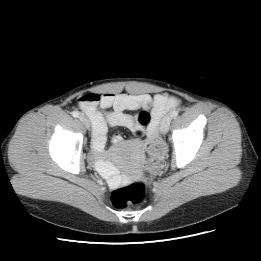 File:Castleman disease with fibrous pseudotumor in the abdomen (Radiopaedia 77296-89373 A 111).jpg