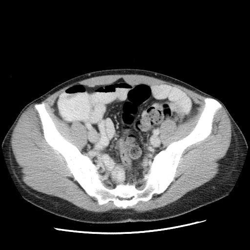 Castleman disease with fibrous pseudotumor in the abdomen (Radiopaedia 77296-89373 A 99).jpg
