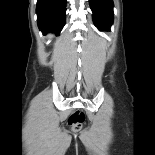 File:Castleman disease with fibrous pseudotumor in the abdomen (Radiopaedia 77296-89373 B 78).jpg