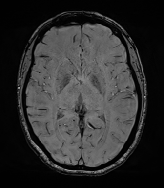 File:Cavernoma with bleed - midbrain (Radiopaedia 54546-60773 Axial SWI 25).png