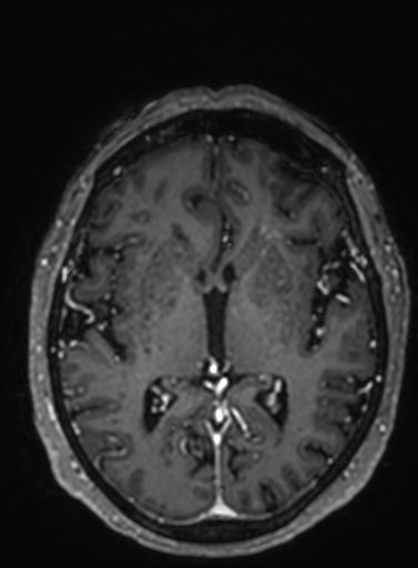 Cavernous hemangioma of the cerebellar falx (Radiopaedia 73025-83724 Axial T1 C+ 167).jpg