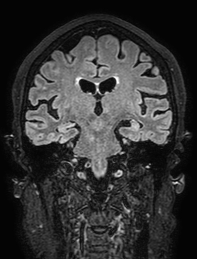 Cavernous hemangioma of the cerebellar falx (Radiopaedia 73025-83724 Coronal FLAIR 191).jpg