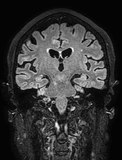 Cavernous hemangioma of the cerebellar falx (Radiopaedia 73025-83724 Coronal FLAIR 195).jpg