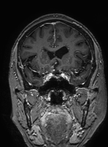 Cavernous hemangioma of the cerebellar falx (Radiopaedia 73025-83724 Coronal T1 C+ 132).jpg