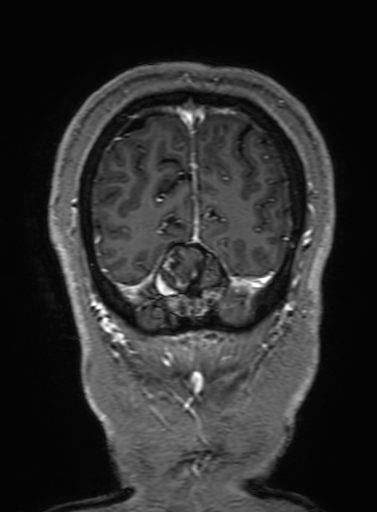 Cavernous hemangioma of the cerebellar falx (Radiopaedia 73025-83724 Coronal T1 C+ 334).jpg