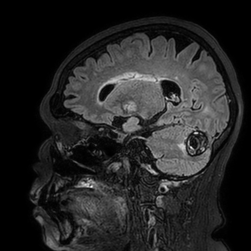 Cavernous hemangioma of the cerebellar falx (Radiopaedia 73025-83724 Sagittal FLAIR 77).jpg
