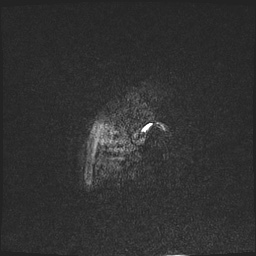 Cavernous sinus meningioma (Radiopaedia 63682-72367 Sagittal T1 C+ 9).jpg