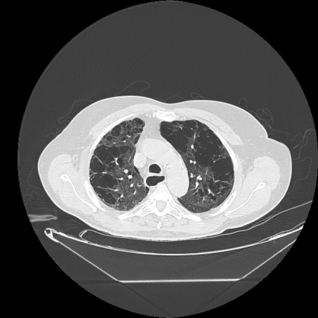 Cavitating bronchogenic carcinoma (Radiopaedia 44489-48162 Axial lung window 22).jpg