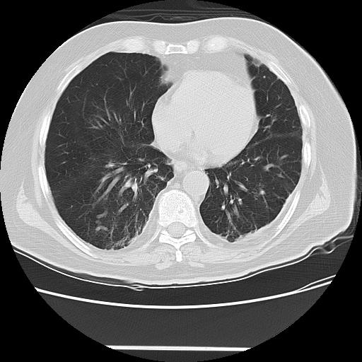 Cavitating pulmonary metastases (Radiopaedia 89545-106544 Axial lung window 38).jpg
