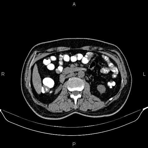 Cecal adenocarcinoma (Radiopaedia 85324-100916 Axial non-contrast 42).jpg