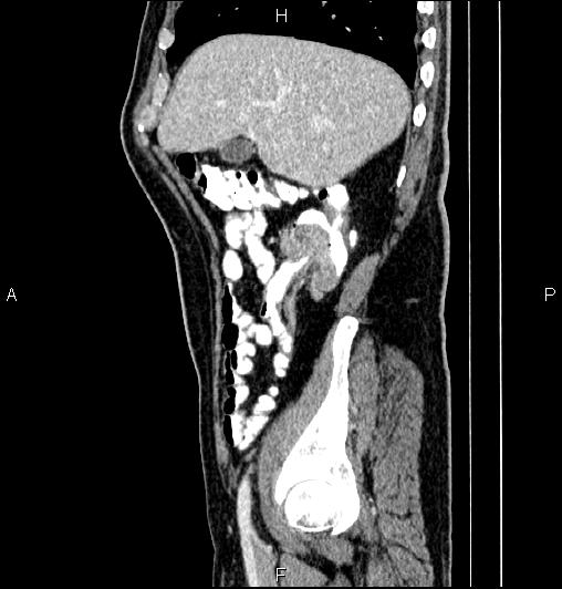 Cecal adenocarcinoma (Radiopaedia 85324-100916 E 21).jpg