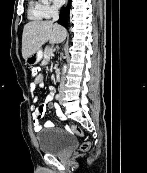 File:Cecal cancer with appendiceal mucocele (Radiopaedia 91080-108651 E 47).jpg