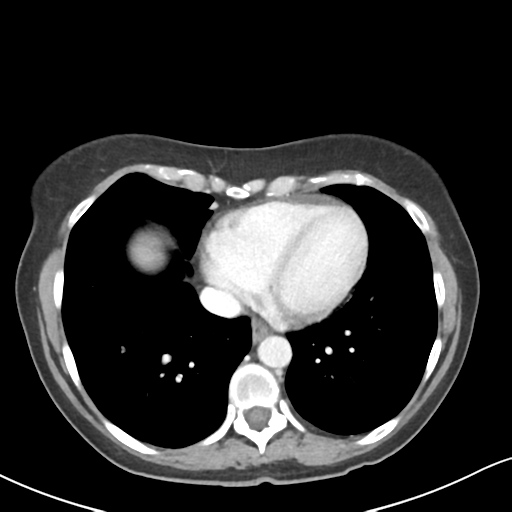 Cecal internal hernia through the foramen of Winslow (Radiopaedia 44820-48651 B 2).png