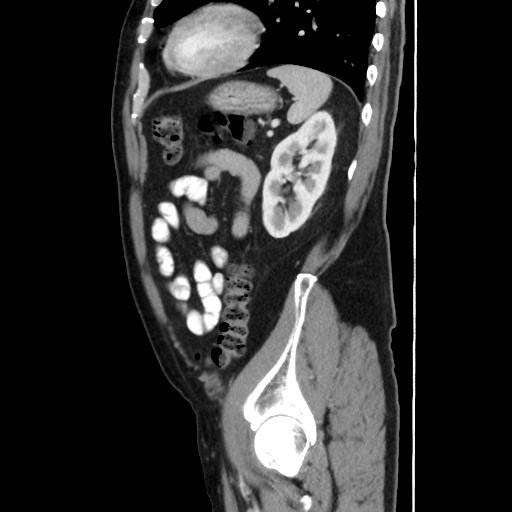 Cecal mass causing appendicitis (Radiopaedia 59207-66531 C 49).jpg