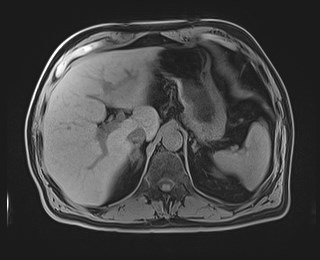 Cecal mass causing appendicitis (Radiopaedia 59207-66532 Axial T1 36).jpg