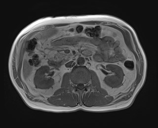 Cecal mass causing appendicitis (Radiopaedia 59207-66532 Axial T1 in-phase 61).jpg