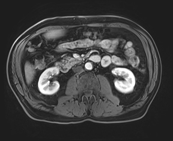 Cecal mass causing appendicitis (Radiopaedia 59207-66532 H 66).jpg