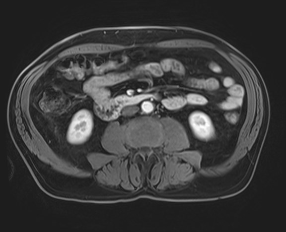 File:Cecal mass causing appendicitis (Radiopaedia 59207-66532 H 75).jpg