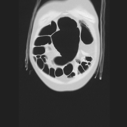 Cecal volvulus (Radiopaedia 75378-86620 Coronal lung window 26).jpg