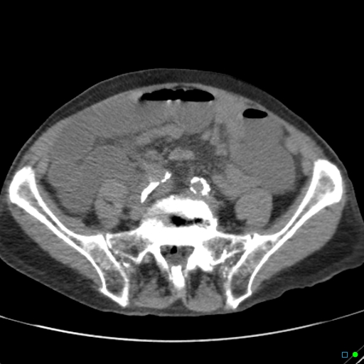 Cecal volvulus - atypical (Radiopaedia 21637-21588 non-contrast 49).jpg