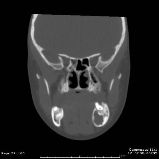 Central giant cell granuloma (Radiopaedia 45612-49754 Coronal bone window 32).jpg