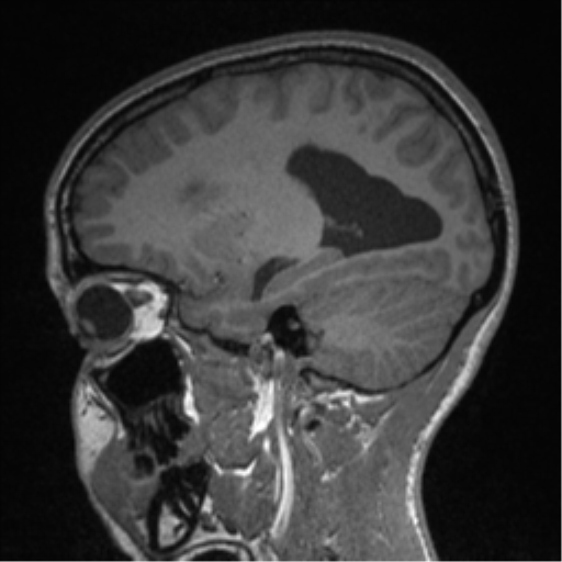 File:Central neurocytoma (Radiopaedia 37664-39557 Sagittal T1 33).png