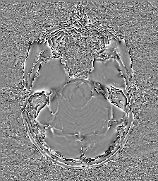 Central neurocytoma (Radiopaedia 84497-99872 Axial 21).jpg