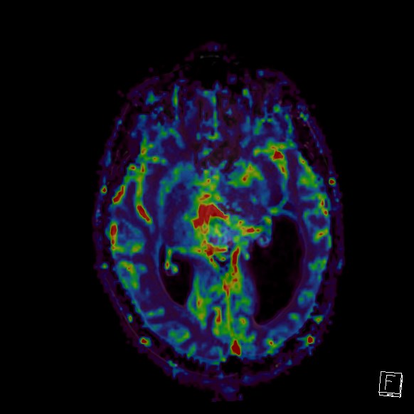 Central neurocytoma (Radiopaedia 84497-99872 Axial Perfusion 174).jpg