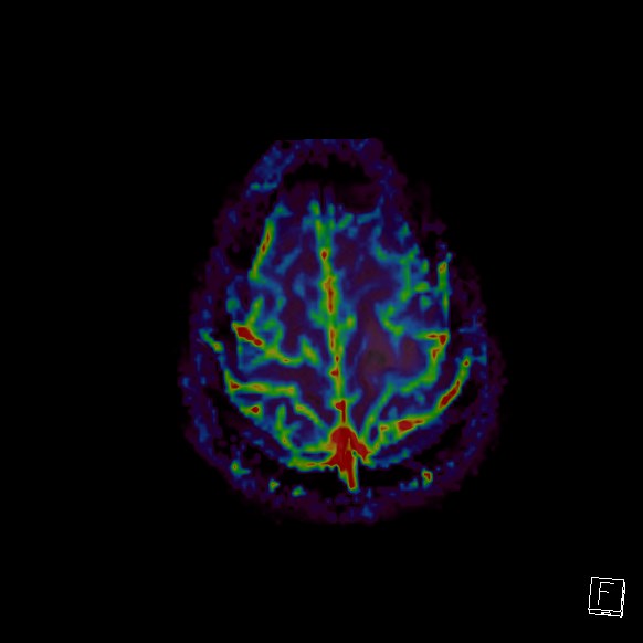 File:Central neurocytoma (Radiopaedia 84497-99872 Axial Perfusion 34).jpg