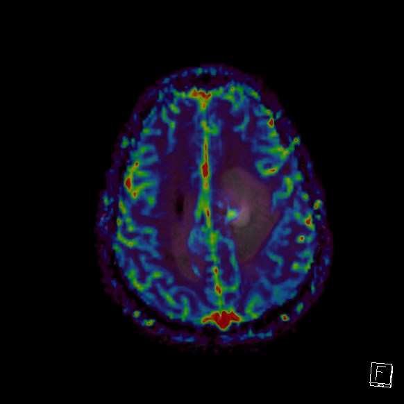 Central neurocytoma (Radiopaedia 84497-99872 Axial Perfusion 86).jpg