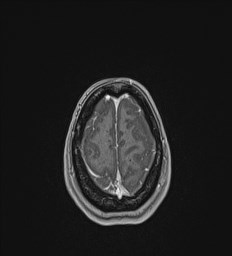 Central neurocytoma (Radiopaedia 84497-99872 Axial T1 C+ 136).jpg