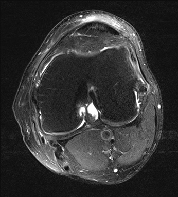 File:Central osteophyte (Radiopaedia 72592-83150 Axial PD fat sat 17).jpg
