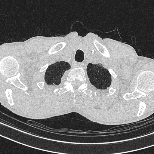 Central venous catheter tip extravasation (Radiopaedia 82828-97113 Axial lung window 12).jpg