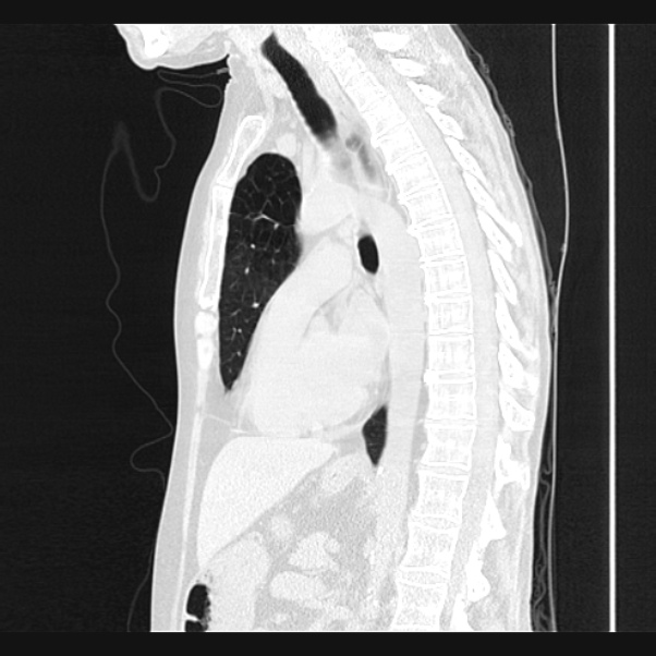 Centrilobular pulmonary emphysema (Radiopaedia 24495-24789 Sagittal lung window 45).jpg