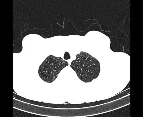 Centrilobular pulmonary emphysema (Radiopaedia 62468-70718 Axial lung window 8).jpg