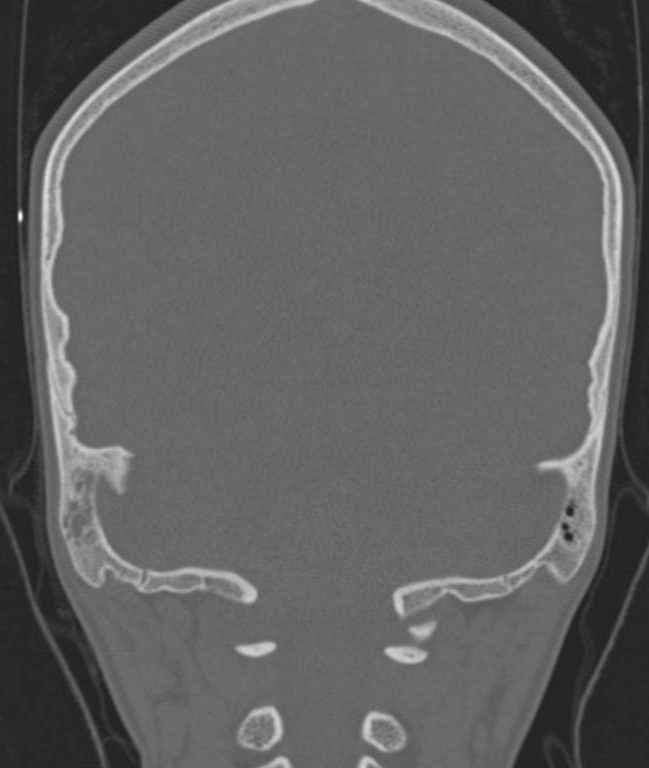 Cerebellar abscess (Radiopaedia 73727-84527 Coronal bone window 28).jpg