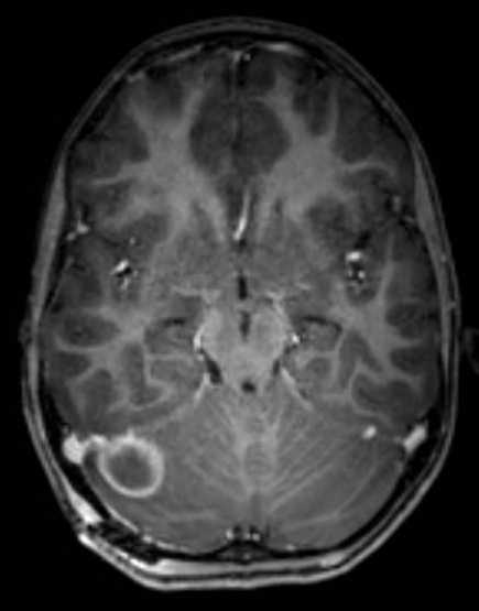 Cerebellar abscess (Radiopaedia 73727-84563 Axial T1 C+ fat sat 55).jpg