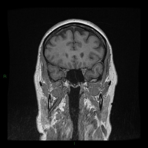 Cerebellar abscess (Radiopaedia 78135-90678 Coronal T1 C+ 50).jpg