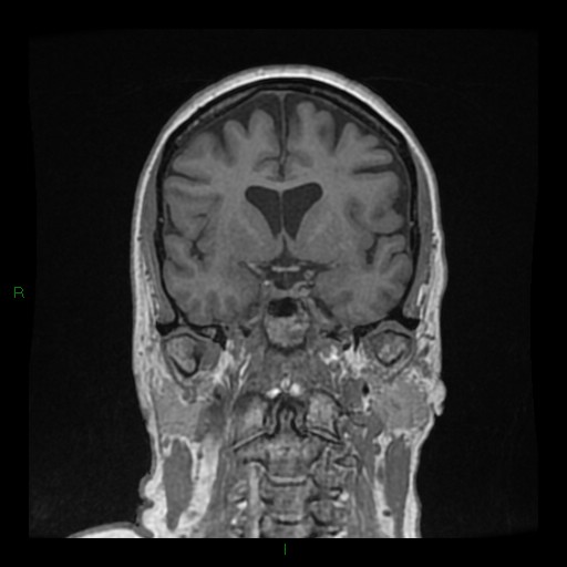 Cerebellar abscess (Radiopaedia 78135-90678 Coronal T1 C+ 67).jpg