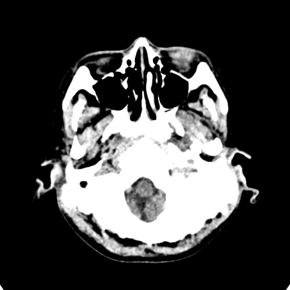 Cerebellar abscess secondary to mastoiditis (Radiopaedia 26284-26412 Axial non-contrast 16).jpg